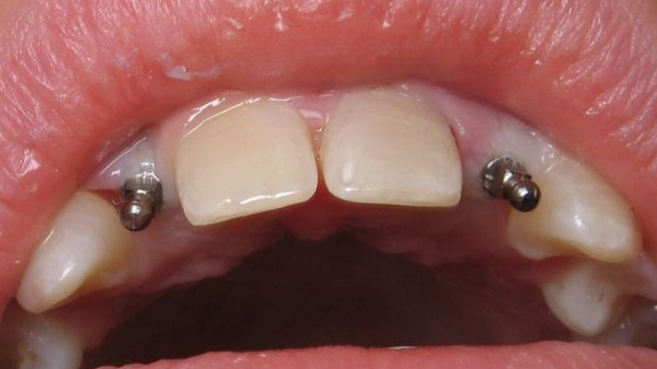 Экспресс имплантация зубов - мифы и действительность