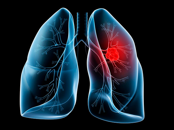 Туберкулёз лёгких